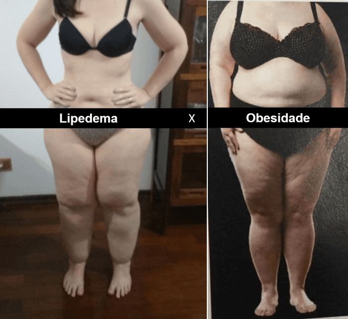 Gordura nos braços, pernas e quadris? Médico explica o que é Lipedema e a diferença com a obesidade