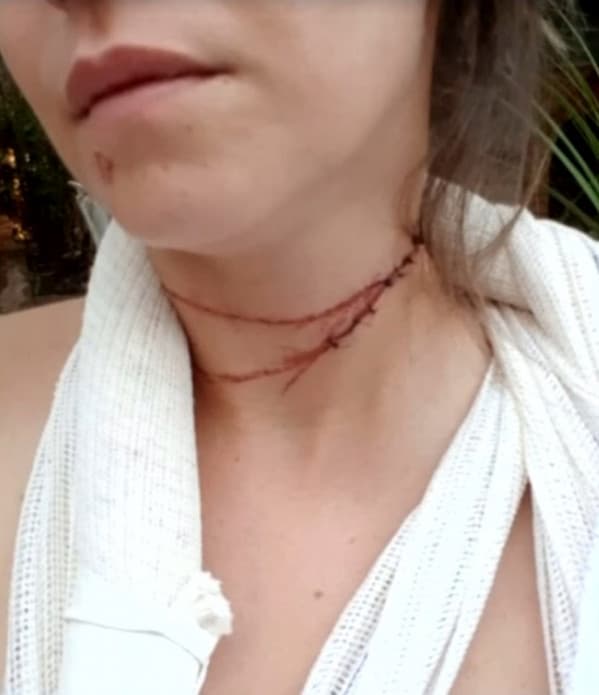 Motociclista fica ferida após ser atingida por linha com cerol em Santa Fé do Sul