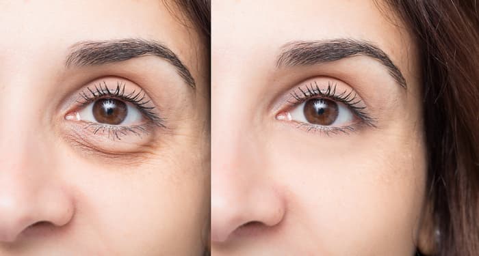 Blefaroplastia nem sempre é indicada para bolsas de gordura sob os olhos