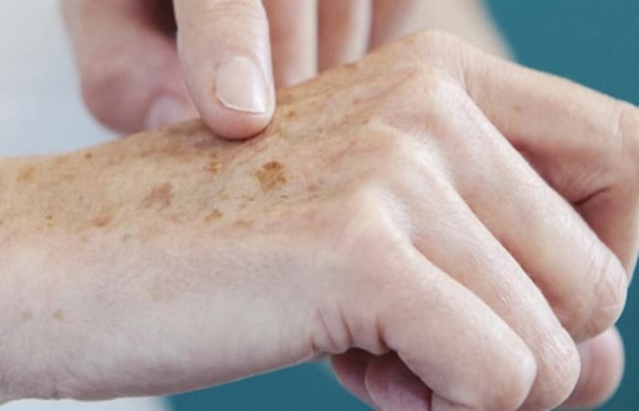 Dezembro Laranja: conheça os sinais de alerta para o câncer de pele no mês de prevenção da doença