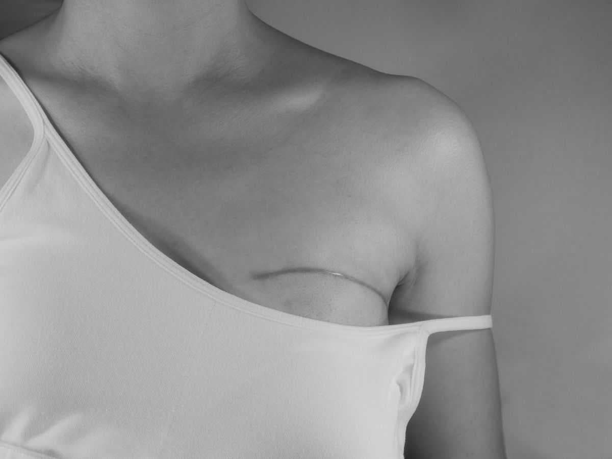 Câncer de mama: chance de cura pode ser de 95% se diagnosticado precocemente