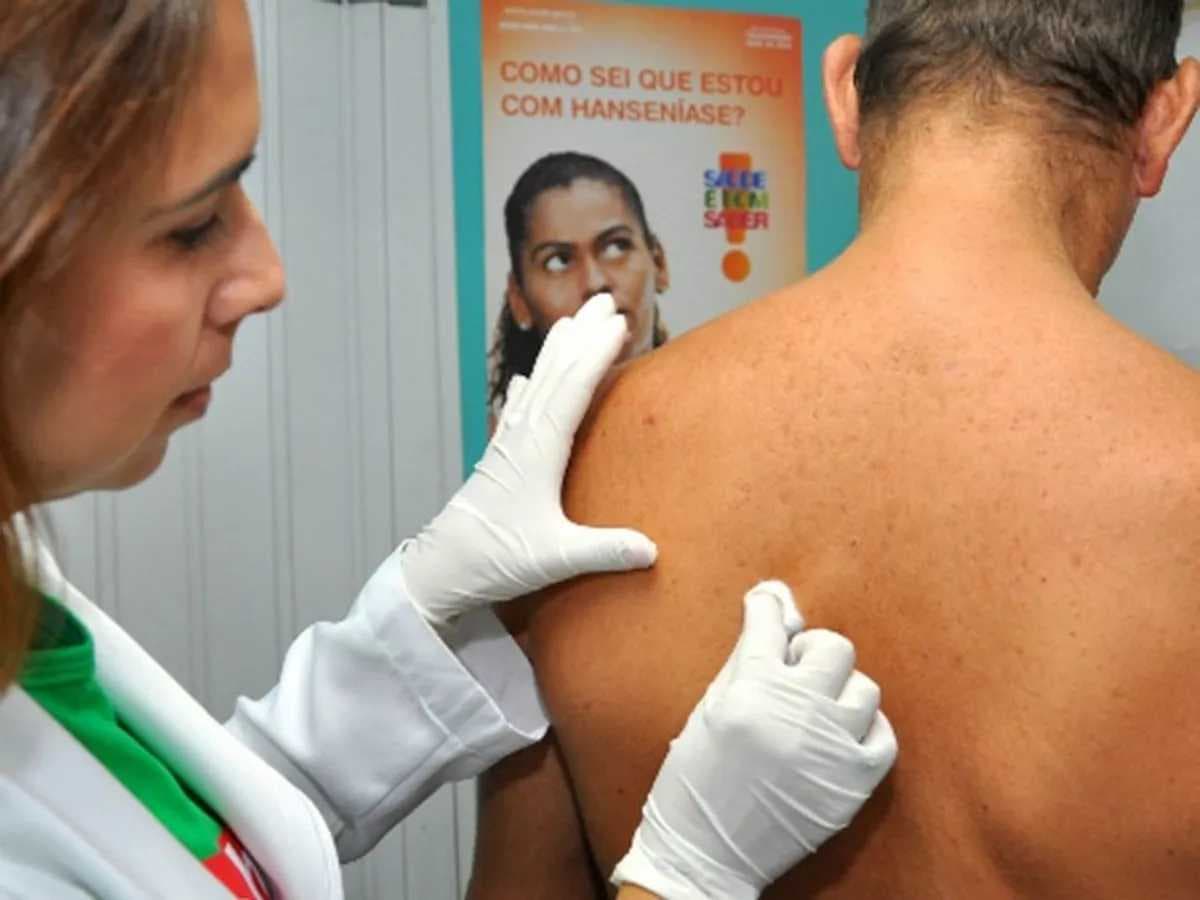 Hanseníase, uma doença cada vez mais comum no Brasil e ela tem cura